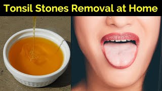 How to Cure Tonsillitis Permanently  Tonsil Stones Removal at Home  Tonsils Home Remedy [upl. by Ardaid387]