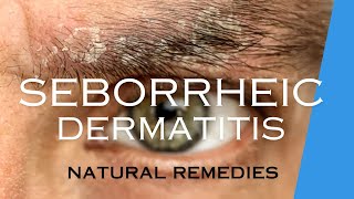 TREAT SEBORRHEIC DERMATITIS with NATURAL REMEDIES [upl. by Lechar]