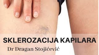 Uklanjanje proširenih kapilara skleroterapija sklerozacija vena cene cena cenovnik [upl. by Ecirtnas]