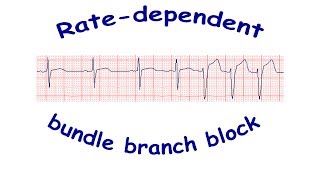 Ratedependent bundle branch block [upl. by Witte]