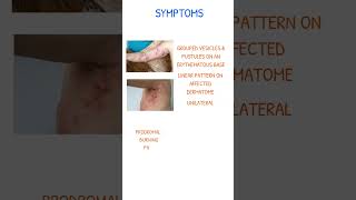 SHINGLES SYMPTOMS [upl. by Neilla]