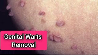 Use these creams to remove genital warts goviral [upl. by Queri]