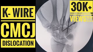 Kwire Fixation of CMC Carpometacarpal Joint Dislocation [upl. by Brodie821]