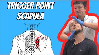 TRIGGER POINT SCAPULA [upl. by Naraa]