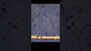 Así se ve una muestra de orina cuando hay INFECCIÓN laboratorioclinico uroanalisis short [upl. by Beata685]