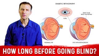 Can Diabetic Retinopathy Be Reversed [upl. by Asiralc]