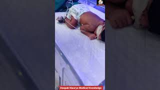 Newborn baby jaundice treatment by phototherapynewborn jaundice phototherapy [upl. by Harrad]