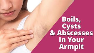 How To Treat Boils Cysts and Abscesses in Your Armpit  Lumps in The Armpit [upl. by Maxine891]