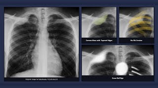 Pleural Lipoma Explanation of Chest Xray Findings [upl. by Sapienza]