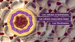 Qu’estce que l’hypertension artérielle pulmonaire  HTAP [upl. by Ettenot]