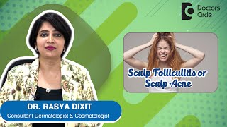 ACNE OR PIMPLES ON SCALP  Scalp Folliculitis  Causes amp Treatment DrRasya Dixit  Doctors Circle [upl. by Akihsar677]