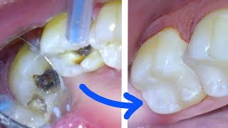 🦷 How a CAVITY amp TOOTH FILLING Procedure Are Done Right by A Dentist White Resin Composite Class 2 [upl. by Bearce872]