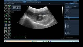 IQ 280 LIVER HEPATOMA ULTRASOUND ECHOPAC ANALYSIS C15RS probe [upl. by Ahsemad]