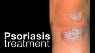 Psoriasis treatment options  related issues [upl. by Nogras]