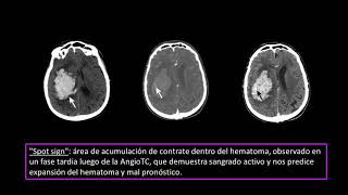 ACV HEMORRÁGICO CG [upl. by Misha]