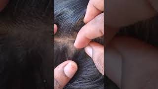 Lice removal video [upl. by Petracca]