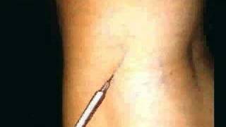 Tratamiento esclerosante de varices  Sclerosing Treatment of Varicose Veins  Sclerotherapy [upl. by Atteirneh261]