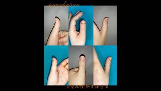 Brachydactyly Type D distraction lengthening brachydactyly doctor thumb meganfox [upl. by Cahilly]