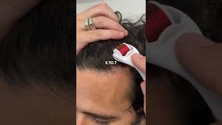 Derma roller hair regrowth treatment 😍💆‍♀️ hairgoals selfcare beautyroutine [upl. by Clemen]