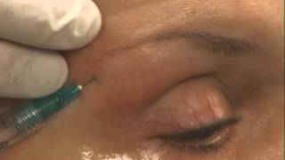 Brow Lift Using Dermal Filler Instructions by Skinspirations [upl. by Cohberg]