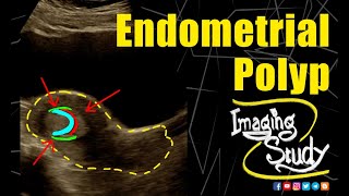 Endometrial Polyp  Ultrasound  Case 250 [upl. by Lipkin662]