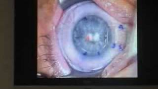 Opération Lasik au Centre Vision Laser Paris Ouest  La Garenne Colombes  FRANCE [upl. by Anahsohs]