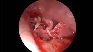 Endoscopic tympanoplasty with Cartilage ossiculoplasty [upl. by Emad]