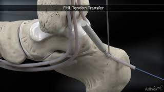 Flexor Hallucis Longus FHL Tendon Transfer [upl. by Valente203]