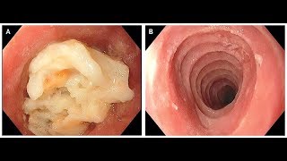 Eosinophile Ösophagitis [upl. by Wershba]