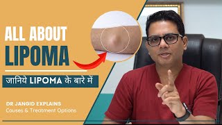 All About Lipoma  What are the causes and treatment options for Lipma  Lipoma Surgery in Delhi [upl. by Rogerg]