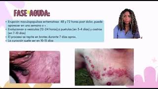 HERPES ZOSTER  Angela Martínez Dermatología [upl. by Rahr]