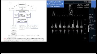 An evidenced based step by step approach to manage a mixed shock by critical care Echocardiography [upl. by Inah]