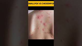 Smallpox vs Chickenpox कौन है ज्यादा Deadly shorts [upl. by Semela]