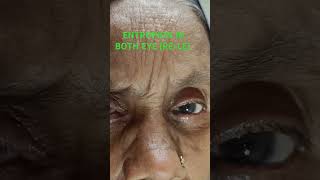 ENTROPION CASEOPHTHALMOLOGY PATIENT ENTROPIONCLINICAL CASE ENTROPIONEYELASHES PROBLEM [upl. by Imac]