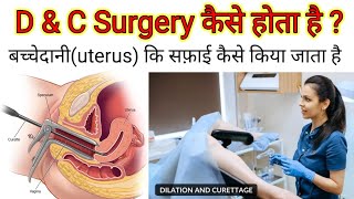 Dilation and curettage D ampC Dos amp Donts after DampC DampE FAQs D amp C सर्जरी कैसे की जाती है [upl. by Nolla]