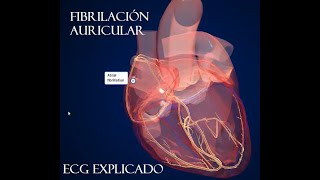 Fibrilación Auricular ECG Patogenia y tratamiento [upl. by Yendis922]