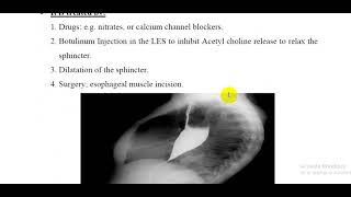 L66 Physiology  Achalasia [upl. by Driskill215]