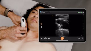 Ultrasound for Subclavian Central Line Placement [upl. by Ecnarret957]