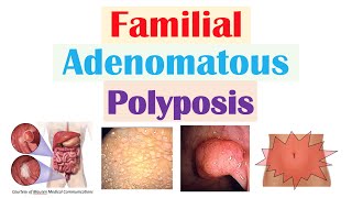 “Colon Cancer That Runs in Families” Familial Adenomatous Polyposis APC Gene Symptoms Treatment [upl. by Finella]