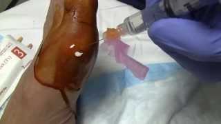 Gout and MTP Joint Arthrocentesis [upl. by Shurlocke]