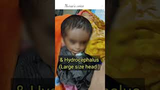 Baby with Talipes Equinoverus Hydrocephalus neonate baby [upl. by Dugas]