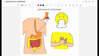 BOERHAAVES SYNDROME [upl. by Nylhtak]