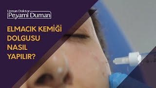 Elmacık Kemiği Dolgusu Nasıl Yapılır [upl. by Harlin]