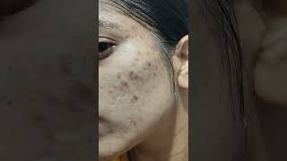 use tretinoin 0025 before and after result face acne darkspots pimpleproblem tretinoin dark [upl. by Kelsi128]