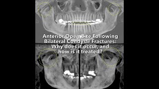 Anterior Open Bite Following Bilateral Condylar Fractures Why does it occur and how is it treated [upl. by Illib]