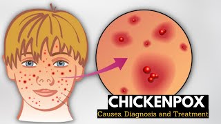 Chickenpox Causes Signs and Symptoms Diagnosis and Treatment [upl. by Nylleoj]