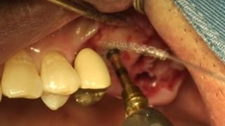 Gentle crestal approach using DASK amp Osteotome [upl. by Sahpec]