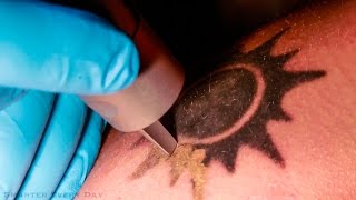 How Laser Tattoo Removal Works  Smarter Every Day 123 [upl. by Anahcra]