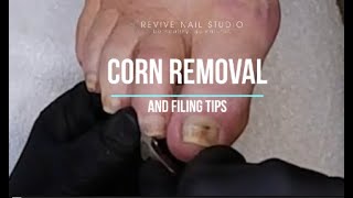 Corn removal pincer nail correction and nail cleaning Oh my pedicuretutorial pedicure corns [upl. by Suoivatnod]