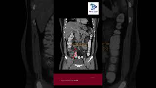 Acute Right iliac fossa pain  Radiology Classic case [upl. by Ylicec480]